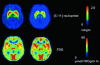 Figure 7 - Metabolic imaging of a patient's brain (in false color) obtained by measuring radioactive glucose concentration using PET. In red, regions of high activity. In blue, areas of low brain activity.