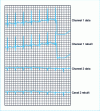 Figure 4 - Original and reconstructed data from the MIT-BIH database, record 116