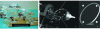 Figure 8 - On the left, a passive registration module in the form of a Z [55]. On the right, an on-board marker on the Mrbot robot's terminal [19].