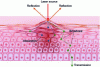 Figure 4 - Illustration of the four types of laser-tissue interaction that occur when the laser passes through biological tissue