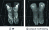 Figure 6 - Visualization of the same medical image using volume rendering: a) MIP rendering; b) composite voxel rendering (source: University of Utah)